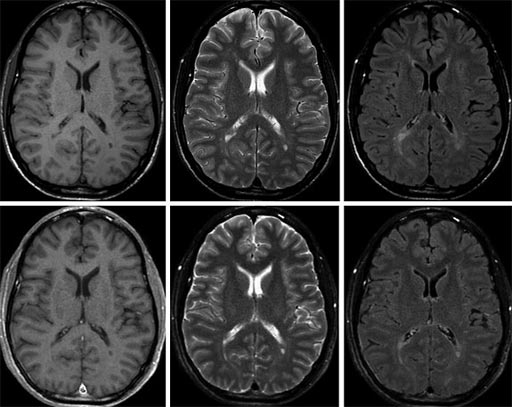 Image: The top images show conventional 1.5T MRI exams, and the lower images show SyMRI exams synthesized in a single scan (Photo courtesy of SyntheticMR).