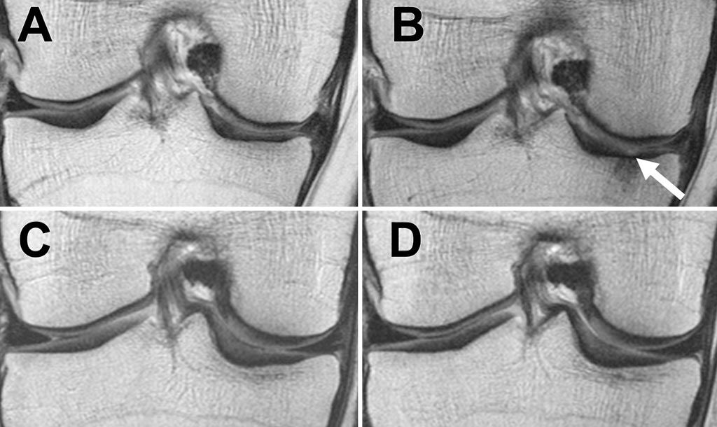Image: MRI scans of the right knee of a patient using the coronal proton density–weighted fast spin-echo fat-suppression sequence (Photo courtesy of RSNA).