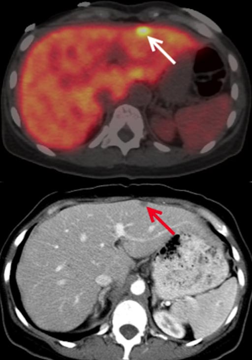 Image: Metastatic pancreatic adenocarcinoma on axial fused PET/CT image with Zr-89 HuMab-5B1, which correlates with increased liver metastasis on diagnostic CT (Photo courtesy of Christian Lohrmann / MSKCC).
