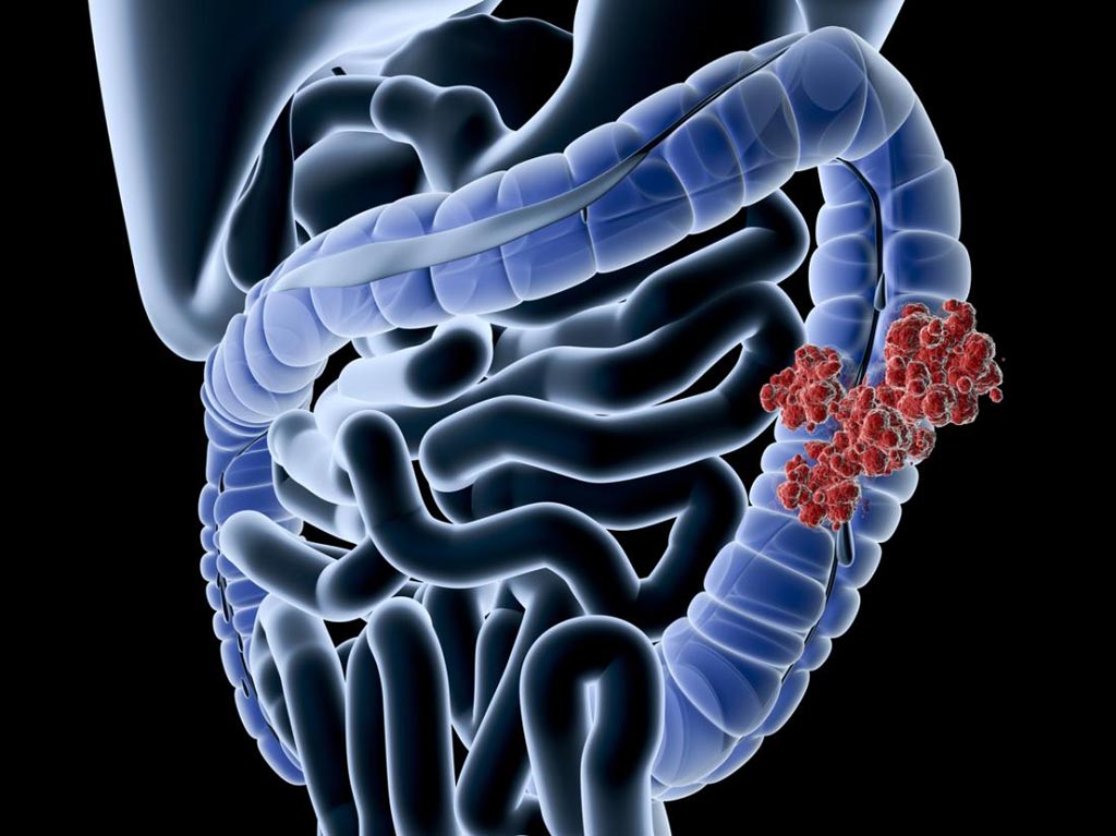 Image: Researchers have found that adding SIRT to chemotherapy may boost colorectal cancer survival (Photo courtesy of MNT).