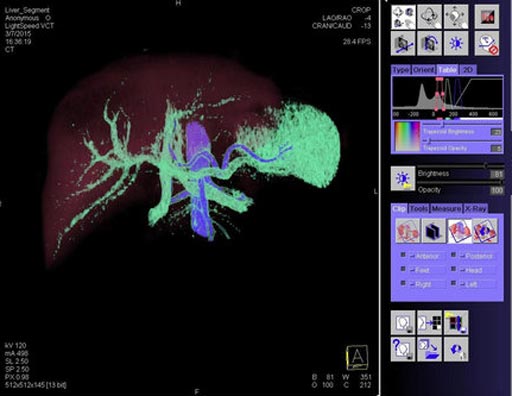 Image: The CT image shows how the surgeons adjusted the trapezoid controls on the table window for improved liver segmentation (Photo courtesy of Siemens Healthcare).