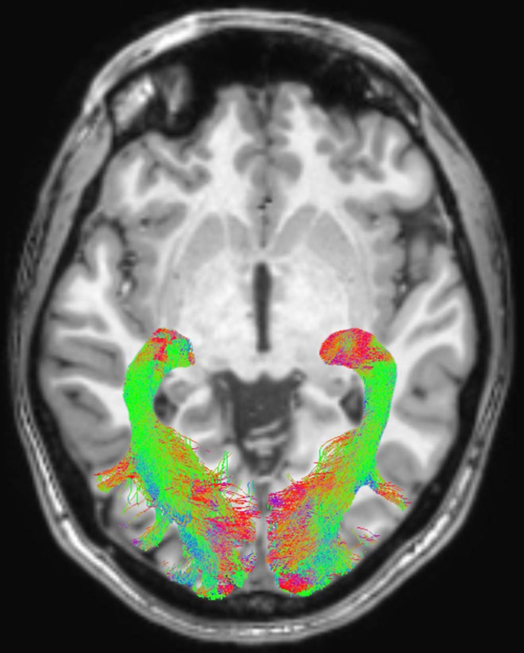 Image: Visual system colored according to tract directionality: red for L to R, green for A to P, and blue for inferior to superior (Photo courtesy of UNISR).
