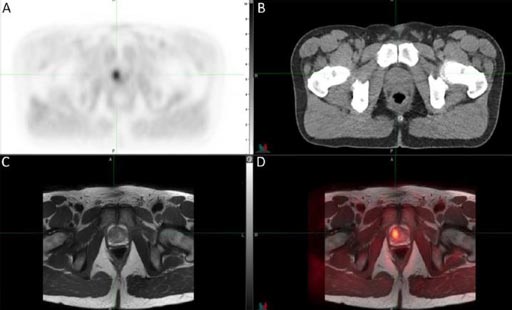Image: A and B show trans-axial 11C-sarcosine hybrid PET/CT images of an adenocarcinoma. Image C shows a separately obtained T2-weighted MR sequence, and Image D shows the resulting PET/MRI registration (Photo courtesy of M. Piert et al., University of Michigan).