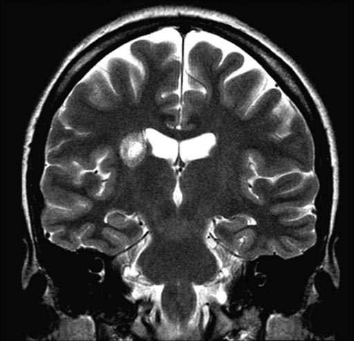 Image: New evidence suggests gadolinium-based contrast agents accrue in the brain (Photo courtesy of Vikas Gulani).