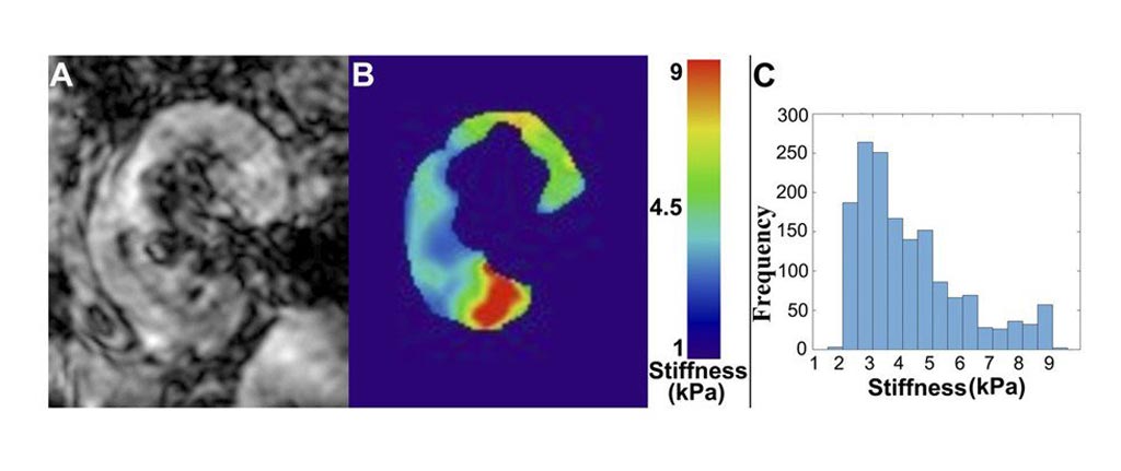 Image: In a new study, MRI elastography demonstrates heterogenous distribution of stiffness in the kidney (Photo courtesy of Anish Kirpalani).