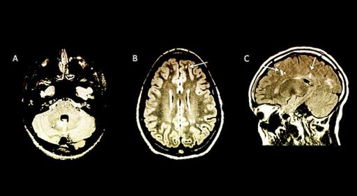 Image: The arrows in the images indicate abnormalities on the children’s MRI brain scans with no apparent symptoms of multiple sclerosis (Photo courtesy of Yale University).