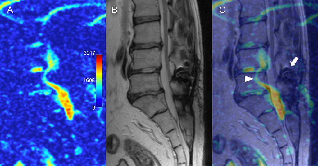 Image: Sagittal ADC map (A), corresponding T2 MRI (B), and colored overlay showing distortion of the signal (C) (Photo courtesy of IRKSMU).