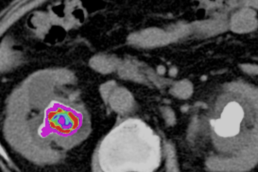 Image: CT texture metrics can identify kidney stone composition (Photo courtesy of StoneChecker).