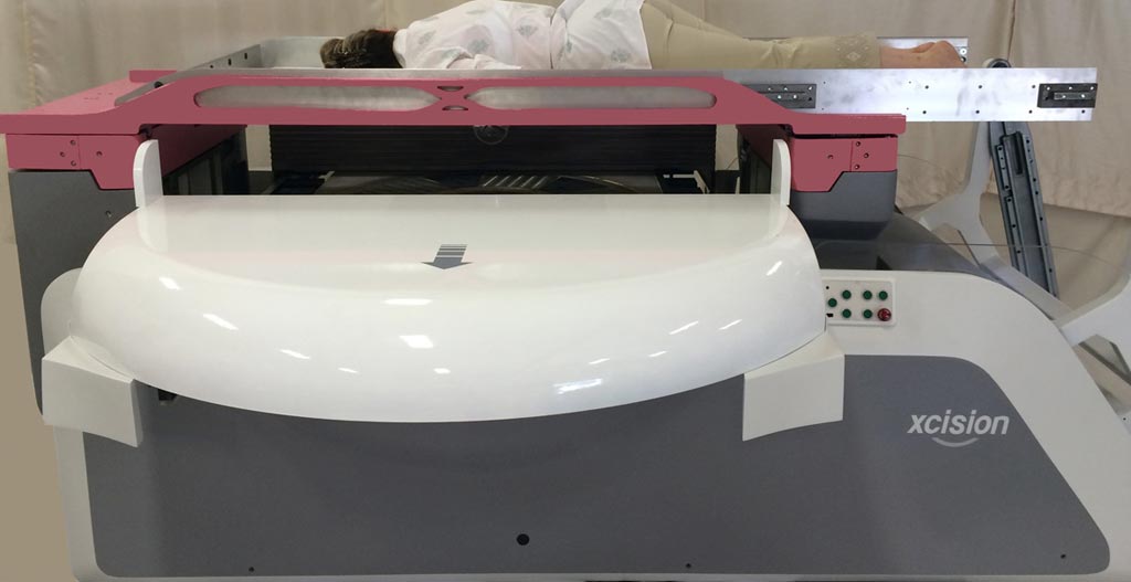 Image: The GammaPod dedicated RT system (Photo courtesy of Xcision Medical Systems).