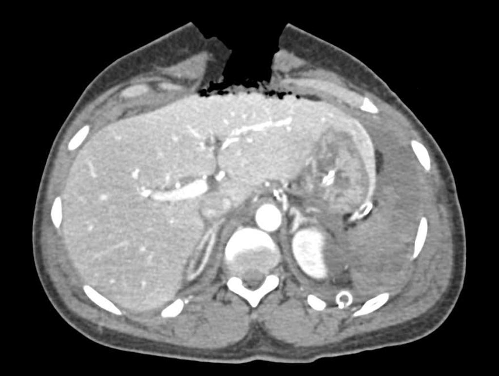 Image: A CT image of an abdominal gunshot wound (Photo courtesy of Ctisus.com).