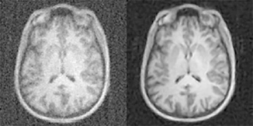 Image: A new artificial-intelligence-based approach to image reconstruction – called AUTOMAP – yields higher quality images from less data, reducing radiation doses for CT and PET and shortening scan times for MRI. Shown here are MR images reconstructed from the same data with conventional approaches (left) and AUTOMAP (right) (Photo courtesy of Athinoula A. Martinos Center for Biomedical Imaging, Massachusetts General Hospital).