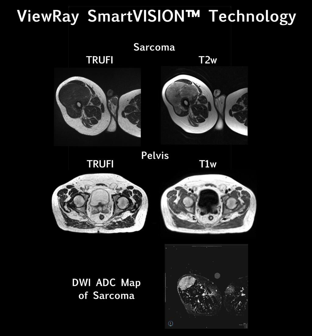 Image: MRIdian SmartVISION enhancements advance cancer RT (Photo courtesy of ViewRay).