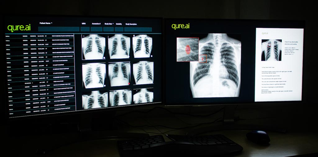 Image: The qXR AI-based chest X-ray interpretation tool has received CE certification (Photo courtesy of Qure.ai).