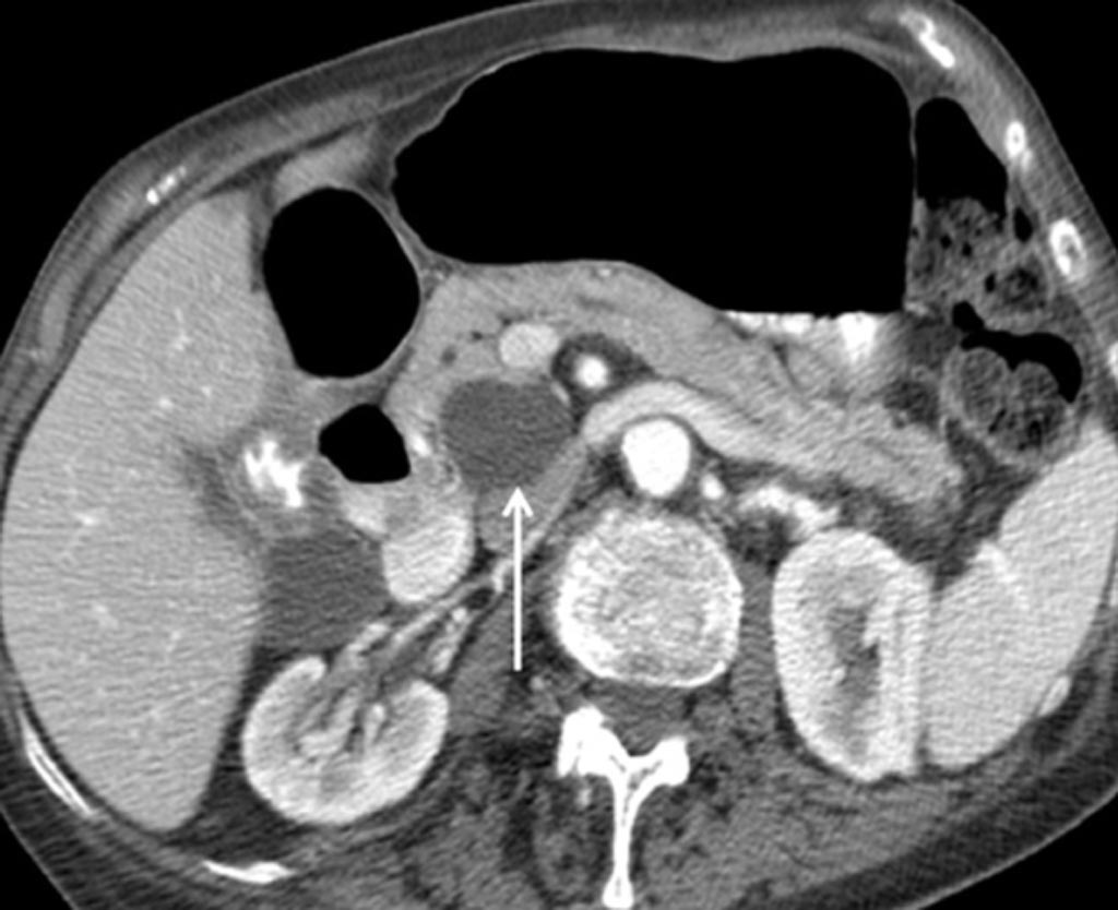Image: Cystic pancreatic incidentaloma in a 75-year-old woman with hematuria (Photo courtesy of NIH).