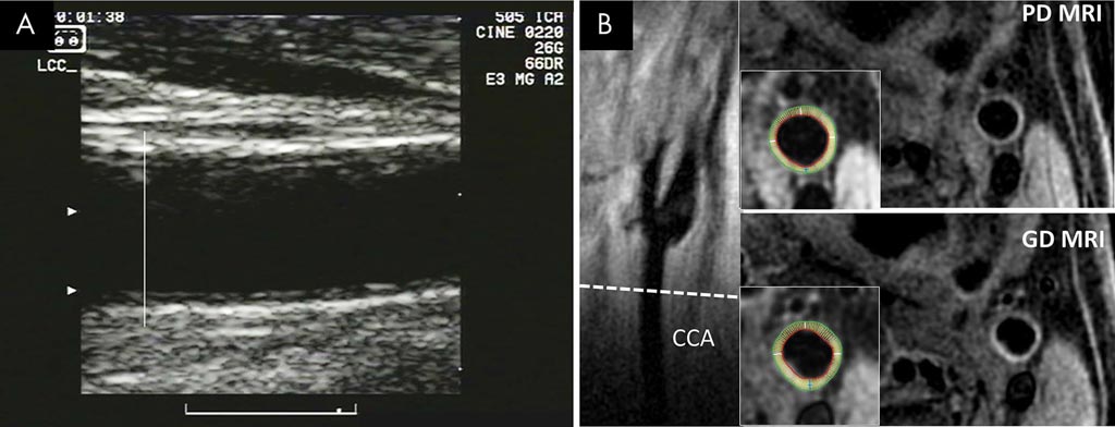 Image: Ultrasound (A) and MRI (B) scans of the common carotid artery (Photo courtesy of Bruce Wasserman/ JHU).