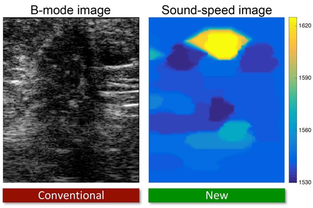 Image: The new ultrasound technique shows a breast tumor in yellow (Photo courtesy of Orçun Göksel / ETH).