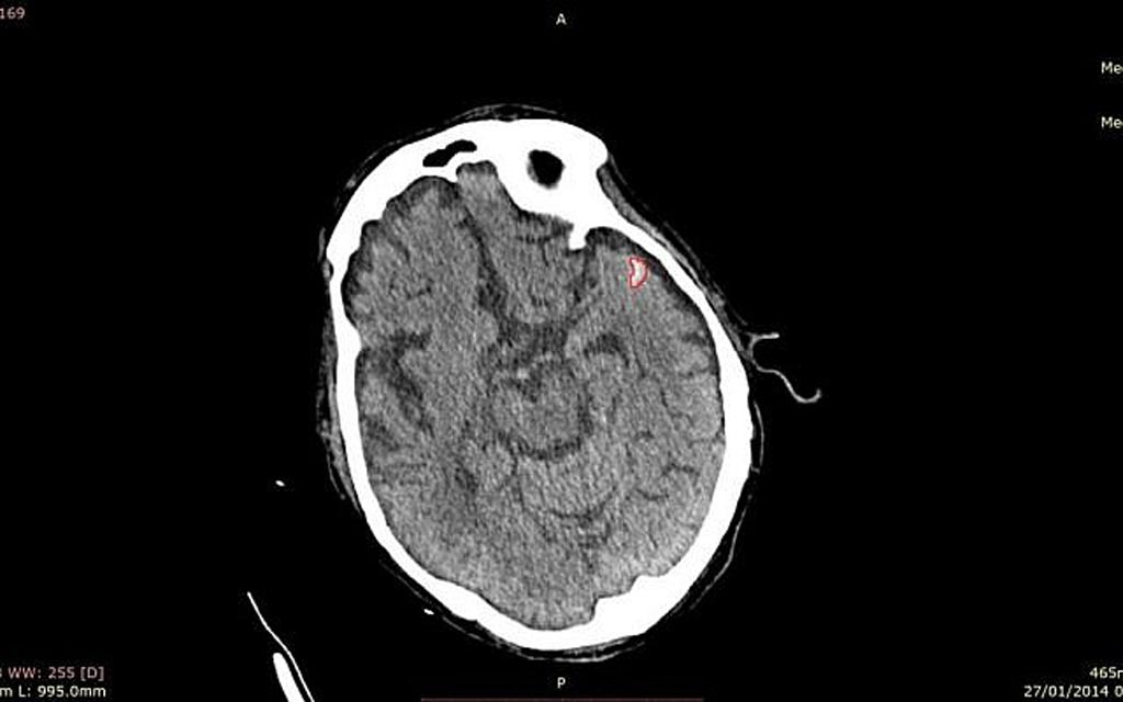 Image: ICH identified on a CT as an aid for stroke assessment (Photo courtesy of MaxQ AI).