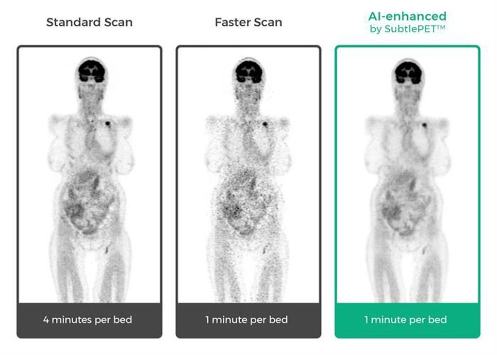 Image: SubtlePET is an AI software product that allows hospitals and imaging centers to efficiently reduce noise and enhance PET image quality (Photo courtesy of Subtle Medical).