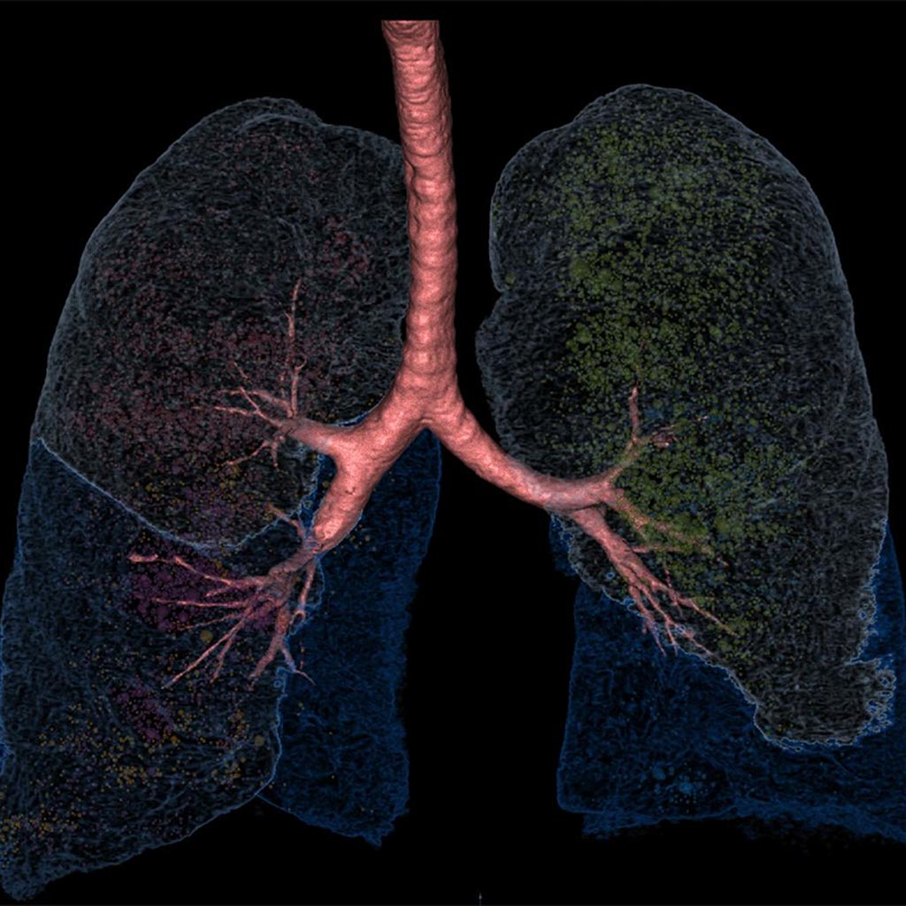 Image: LungPrint Discovery is designed as an artificial intelligence (AI)-powered lung analysis solution for radiologists (Photo courtesy of VIDA Diagnostics).