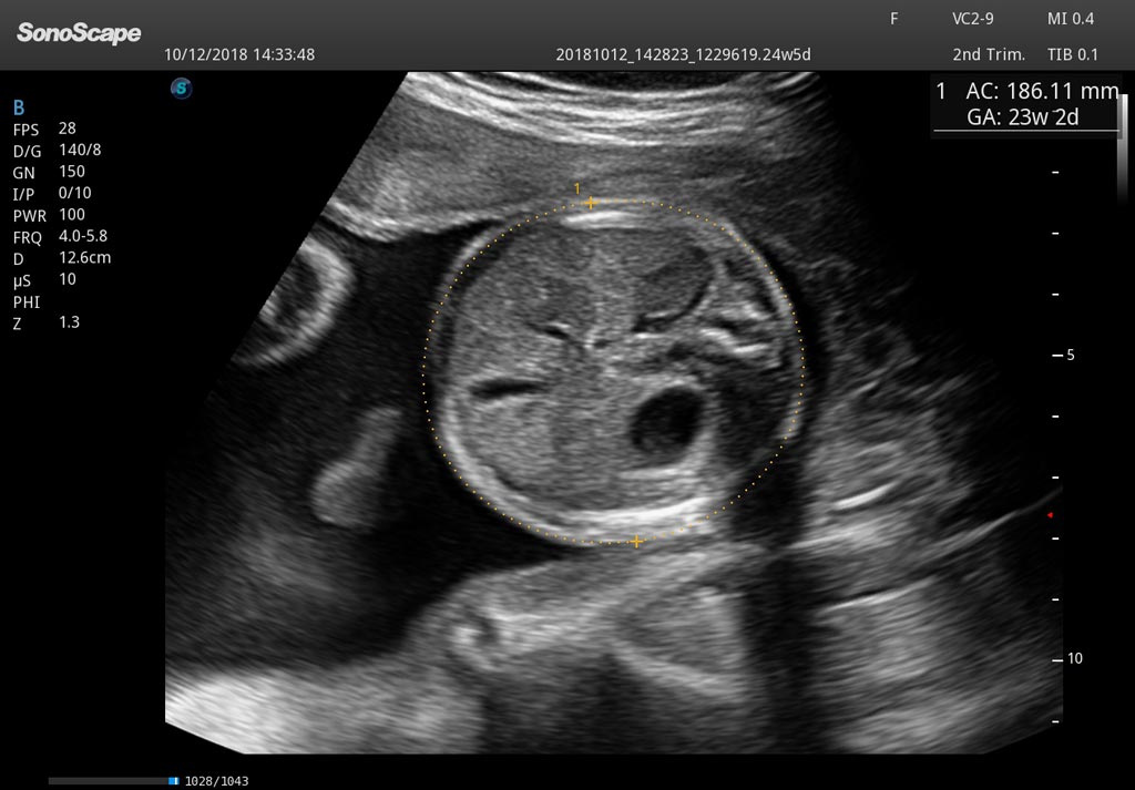 Image: Deep learning and artificial intelligence (AI) transform obstetric ultrasound exams into an easier, faster, more consistent and far more accurate experience (Photo courtesy of SonoScape).