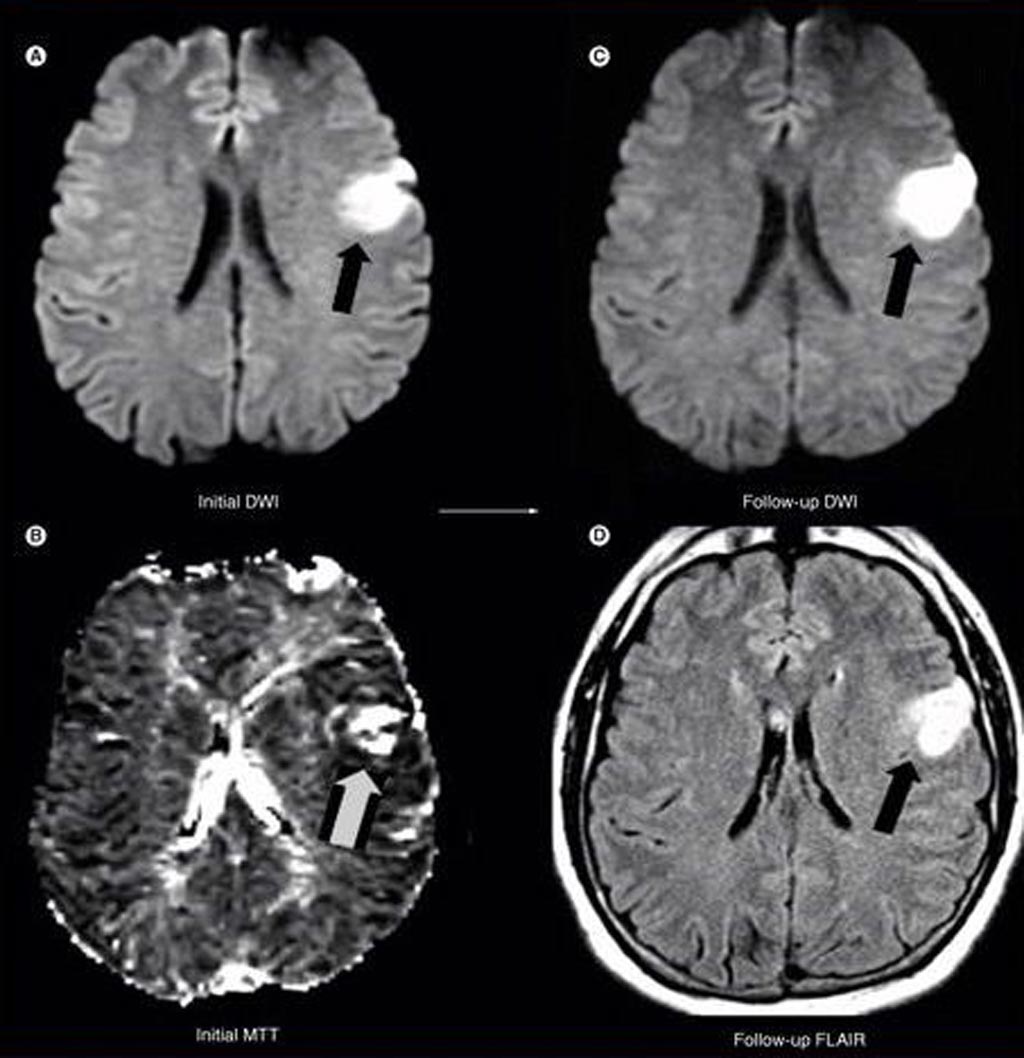 Image: As part of a new study, researchers found that for stroke patients treated 3-6 hours after onset with intravenous tPA, baseline MRI findings can identify subgroups that are likely to benefit from reperfusion therapies and can potentially identify subgroups that are unlikely to benefit or may be harmed (Photo courtesy of Medscape).