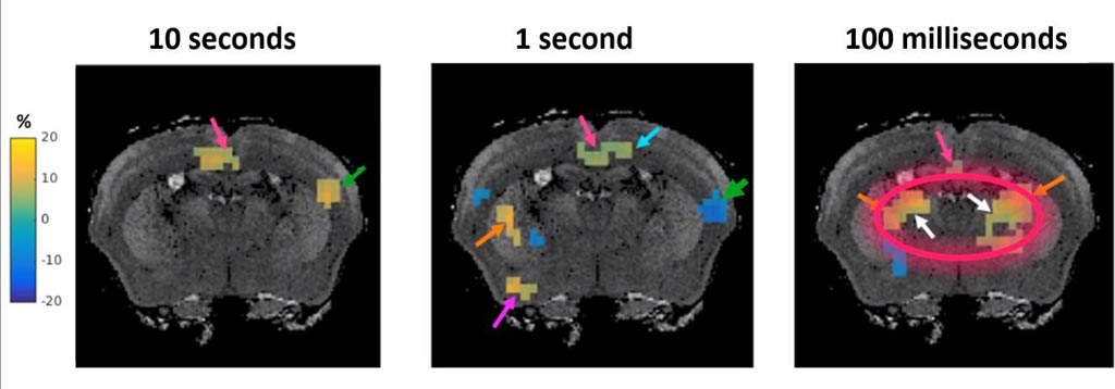 Image: Magnetic resonance elastography (MRE) can show millisecond brain activity (Photo courtesy of Science Advances).