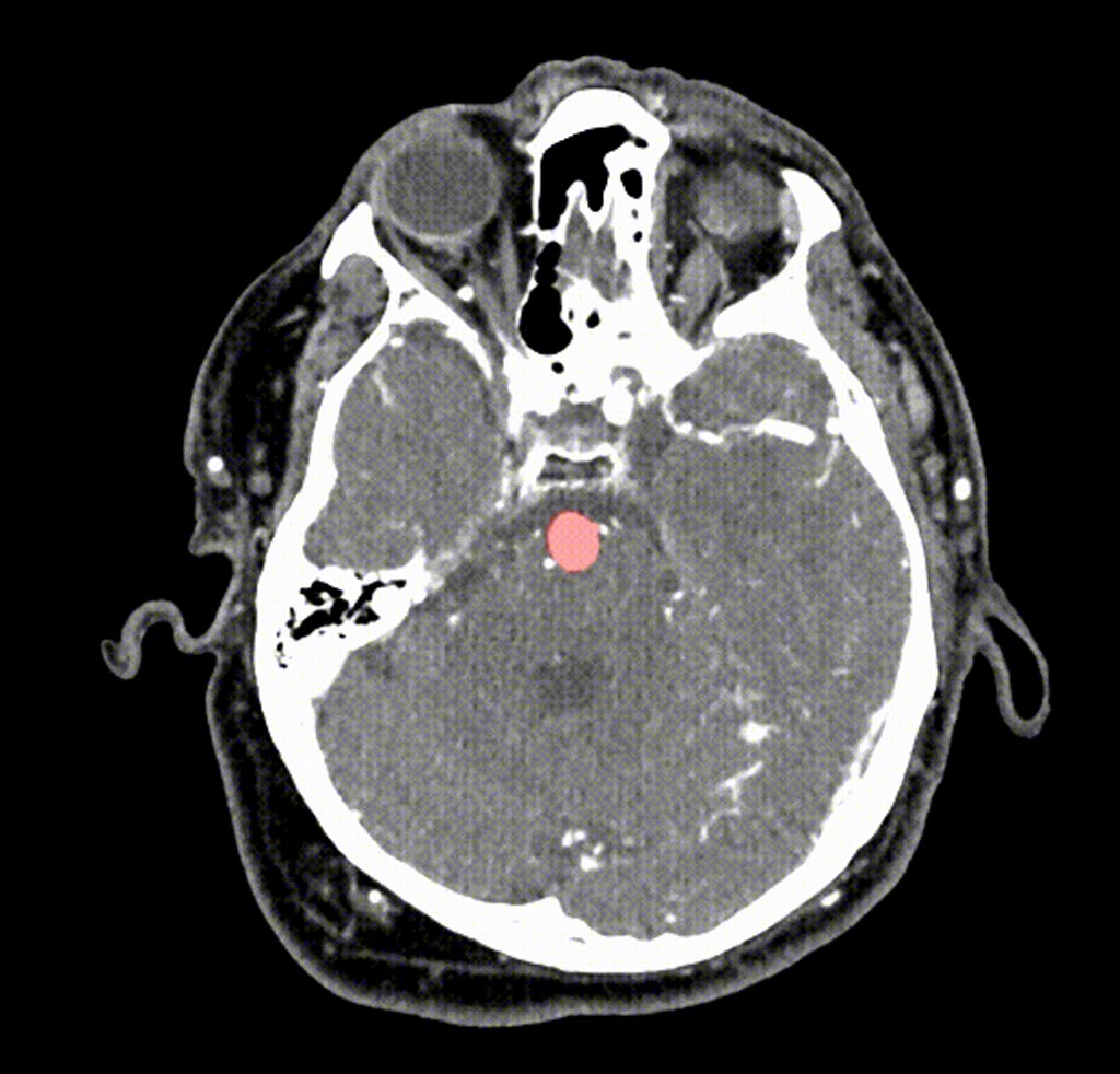 Image: In this brain scan, the location of an aneurysm is indicated by HeadXNet using a transparent red highlight (Photo courtesy of Allison Park).