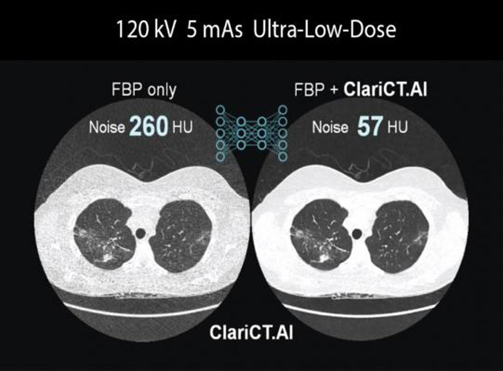 Image: An imaging suite removes noise from CT images (Photo courtesy of ClariPi).