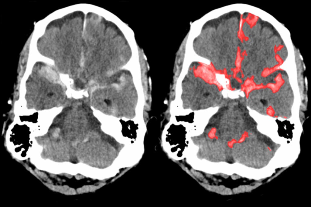 Image: Typical brain scan a radiologist would see (L), and a subarachnoid hemorrhage highlighted by PatchFCN (R) (Photo courtesy of UCSF).
