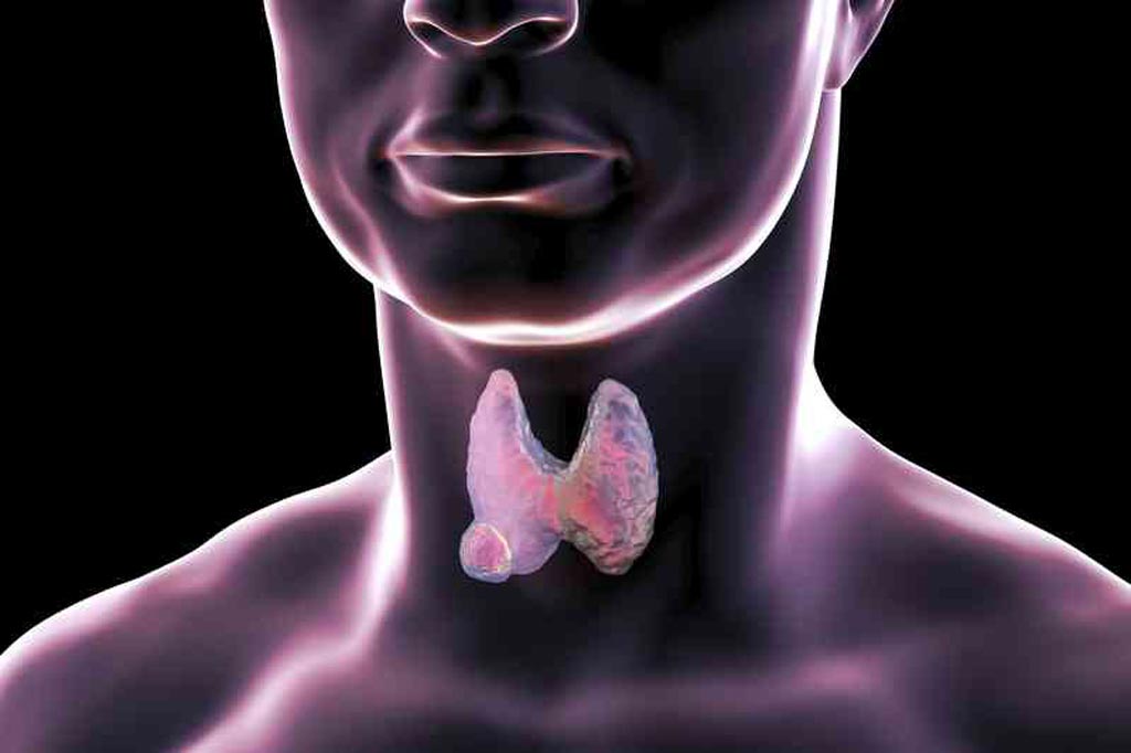 Image: Abnormal thyroid gland with Hashimoto’s disease (L) and a normal gland (R) (Photo courtesy of 123rf.com).
