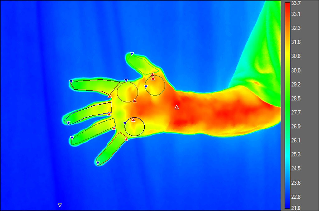 Image: A thermographic heat map of a hand and wrist (Photo courtesy of Staffordshire University)