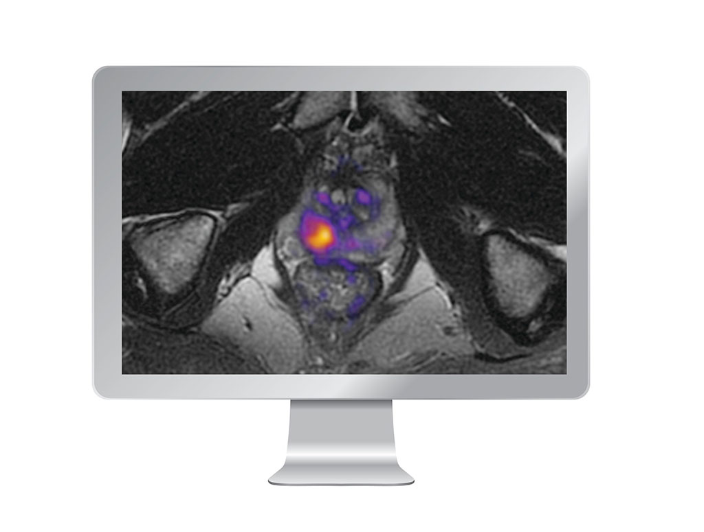 Image: RSI-MRI+ increases the visibility of restricted water in prostate tumors (Photo courtesy of HealthLytix)
