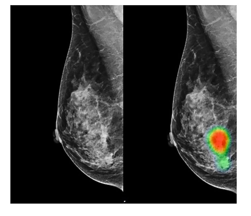 Image: Invasive lobular carcinoma of the breast (Photo courtesy of Lunit)