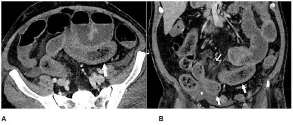 Image: Axial (A) and coronal (B) CT of the abdomen suggestive of early ischemia (Photo courtesy of RSNA)