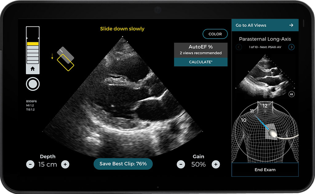 Image: AI-Guided Imaging Software (Photo courtesy of Caption Health)