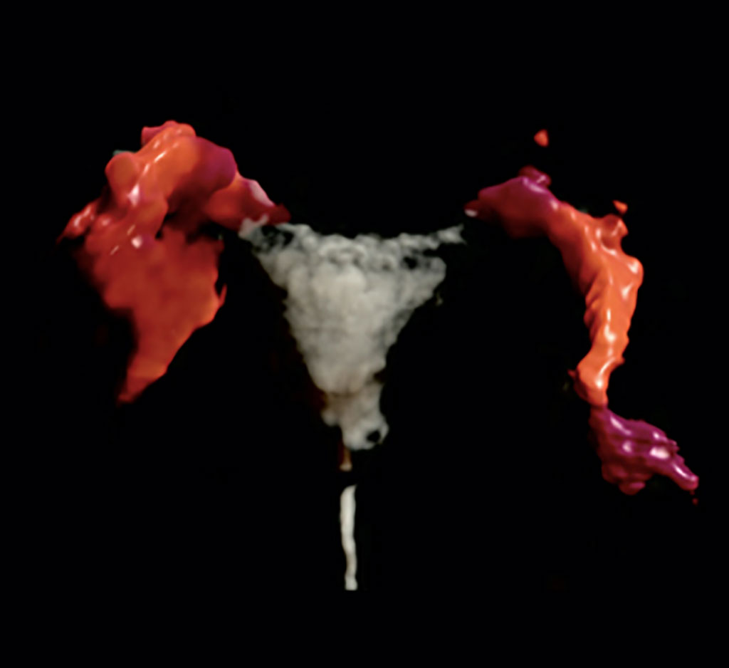 Image: HyFoSy image of the uterus and fallopian tubes (Photo courtesy of ExEm Foam)