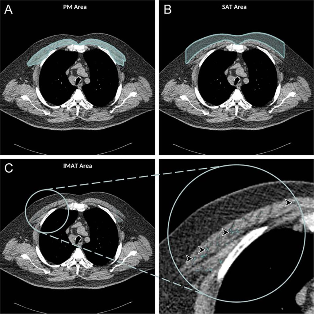 Image: Axial chest CT showing PM, SAT, and IMAT areas (arrowheads) (Photo courtesy of RSNA)