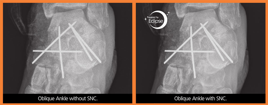 Image: The same image with and without SNC (Photo courtesy of Carestream)