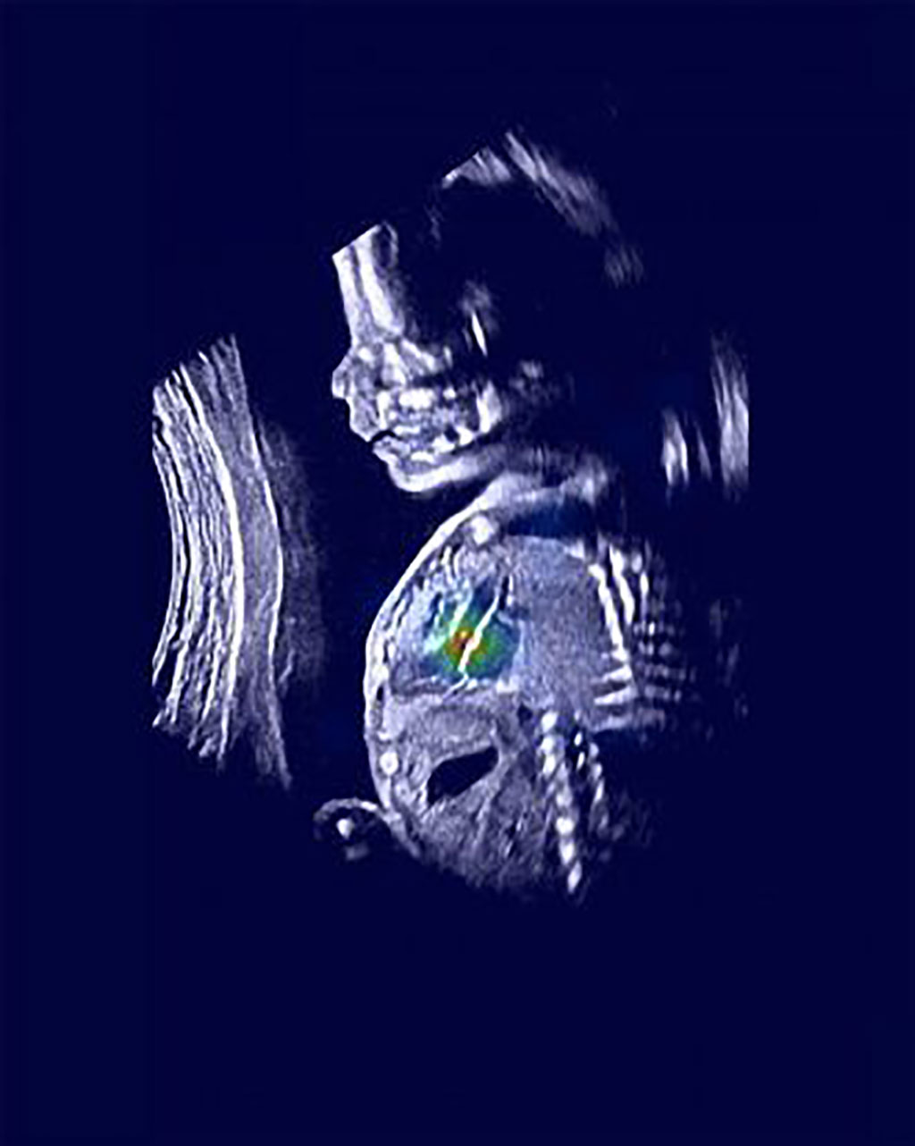 Image: An ultrasound image shows a normal fetus with relevant heart structures precisely highlighted (Photo courtesy of Rima Arnaout)