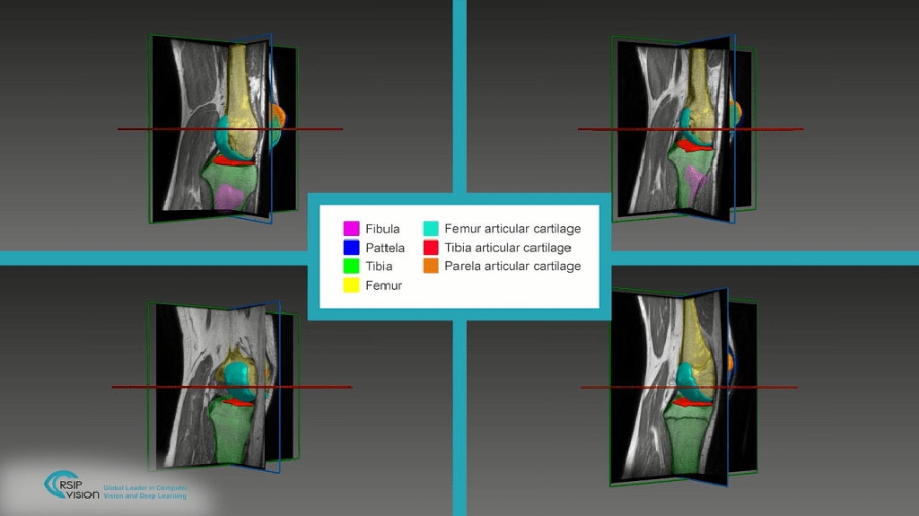 A novel AI tool aids articular cartilage segmentation (Photo courtesy of RSIP Vision)
