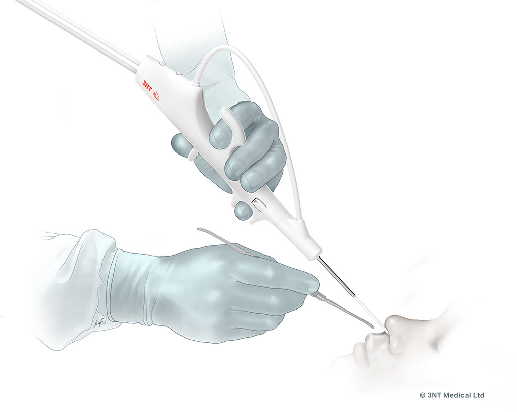 Image: Drivable Sinus Endoscope Offers Enhanced Maneuverability (Photo courtesy of 3NT Medical)