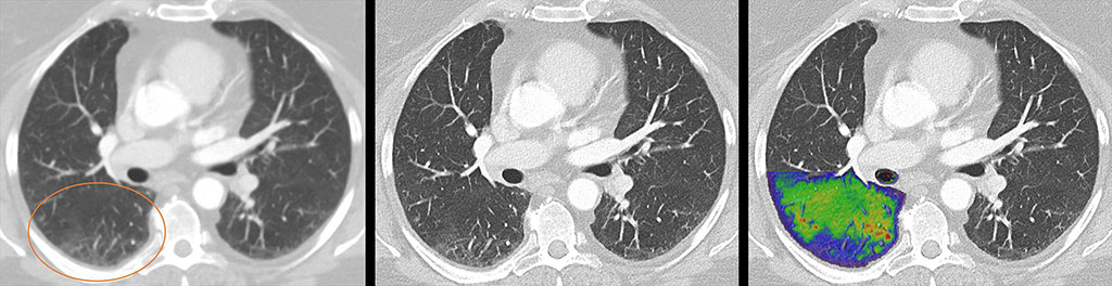 Image: NAEOTOM Alpha lung image of a post COVID19 patient (R), compared to conventional CT (L) (Photo courtesy of J. Ferda/ University Hospital Plzen)