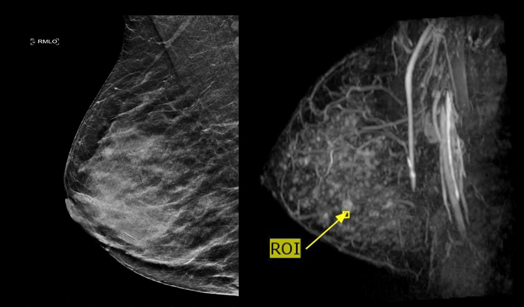 Image: AB-MRI (R) reveals a 10mm mass, not seen on mammogram (L) due to marked breast density (Photo courtesy of St. Vincent`s Private Hospital)