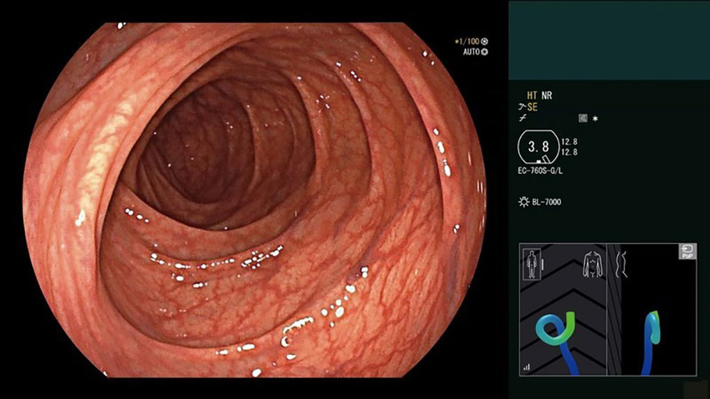 Image: The ColoAssist PRO endoscope visualization system (Photo courtesy of Fujifilm Medical Systems)