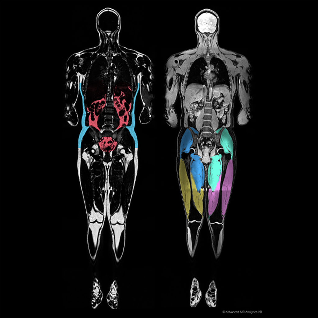 Image: A graphical MAsS score of visceral fat (L) and muscle (R) (Photo courtesy of AMRA medical)