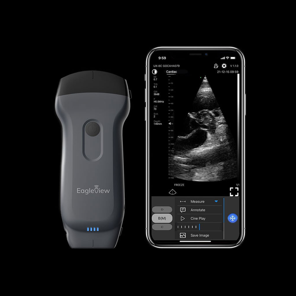 Image: The EagleView POCUS probe (Photo courtesy of EagleView)