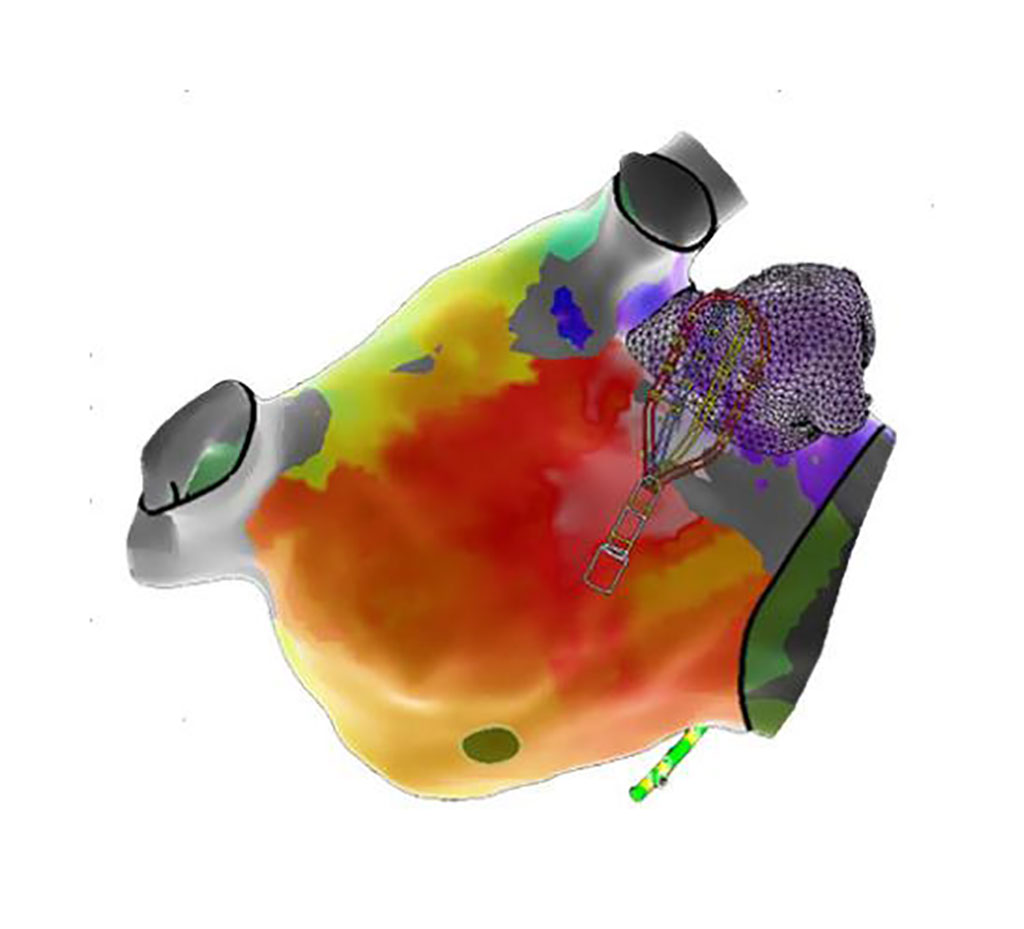 Image: 3D cardiac map created with the EnSite X EP mapping system with OT (Photo courtesy of Abbott)
