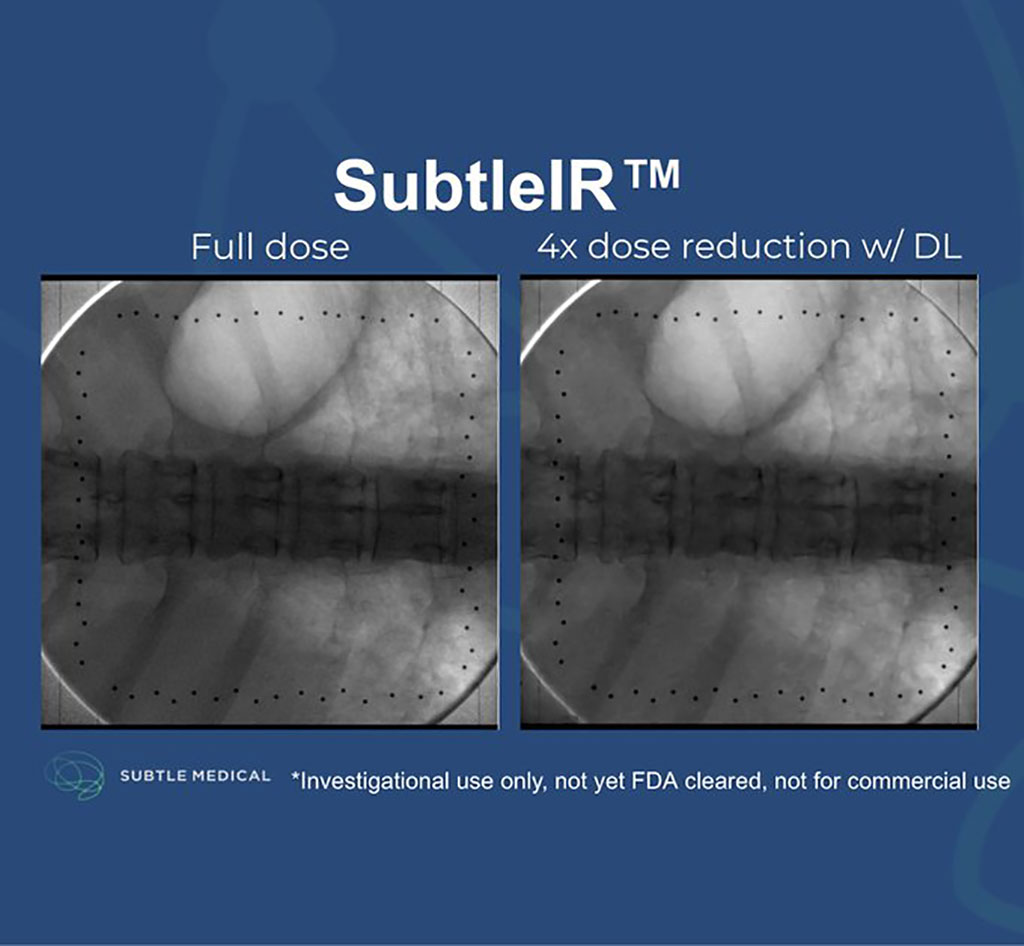 Image: SubtleIR AI software (Photo courtesy of Subtle Medical, Inc.)