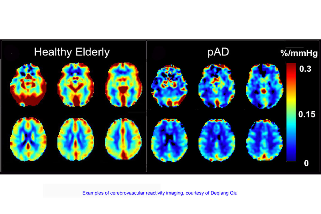 Image: Examples of cerebrovascular reactivity imaging (Photo courtesy of Deqiang Qiu)