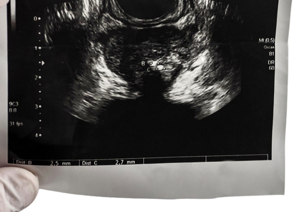 Image: Ultrasound scan can detect cases of prostate cancer (Photo courtesy of Imperial College London)